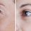 All You Need To Know About Double Eyelid Surgery in Singapore