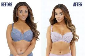 Breast-Reduction-Before-and-After
