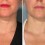 Tips to Get Rid of Neck Wrinkles