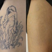 Tattoo-Removal