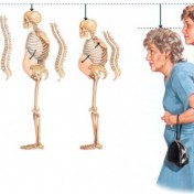 Osteoporosis-Signs