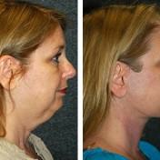 mini-facelift-before-and-after