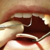 Teeth Removed