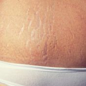 Home Treatment to Prevent Stretch Marks
