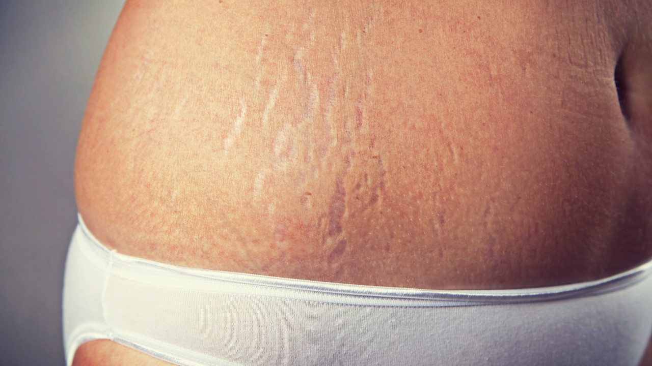 Home Treatment to Prevent Stretch Marks