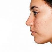 Tips on how to treat ACNE